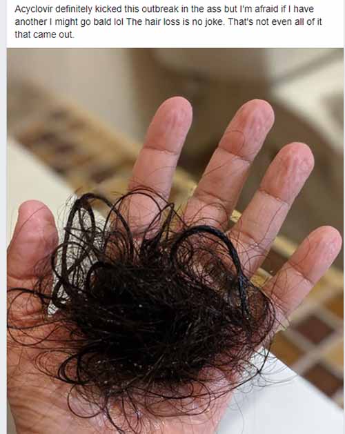 Can Acyclovir cause your hair loss?